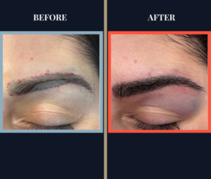 Eyebrow Hair Transplant FUT Day of Surgery Before and After Photo