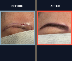 Eyebrow Hair Transplant - FUT 900 graft post-op photo