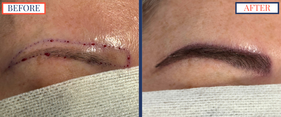 Eyebrow FUT - POST-OP Zoom on Left Brow