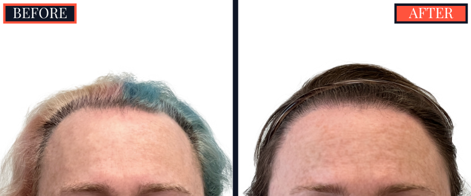 1810 GRAFT FUE HAIR TRANSPLANT RESULTS