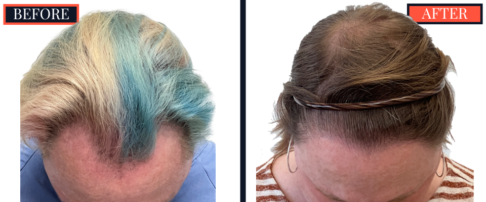 1810 GRAFT FUE HAIR TRANSPLANT RESULTS