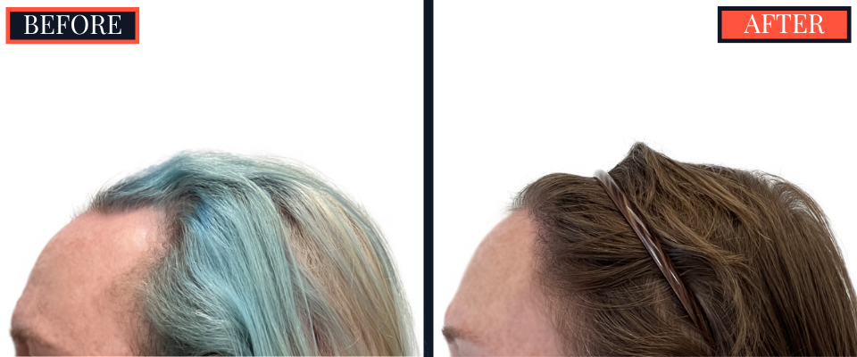1810 GRAFT FUE HAIR TRANSPLANT RESULTS