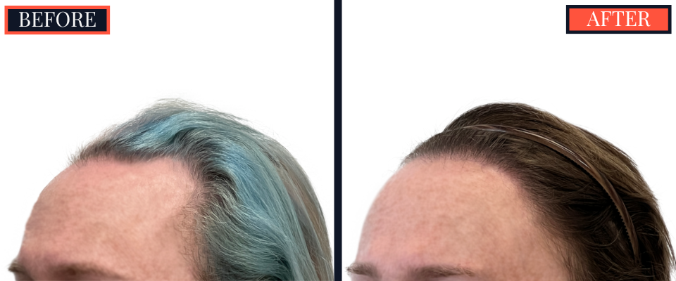 1810 GRAFT FUE HAIR TRANSPLANT RESULTS