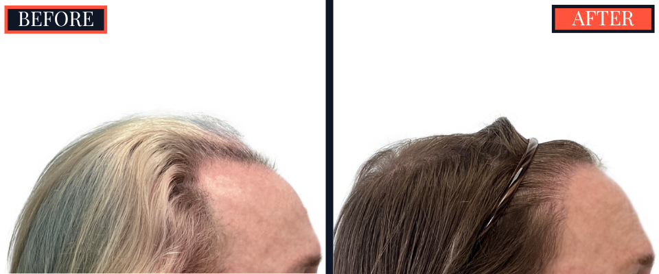 1810 GRAFT FUE HAIR TRANSPLANT RESULTS