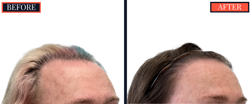 1810 GRAFT FUE HAIR TRANSPLANT RESULTS