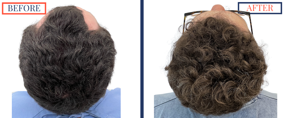 1385 graft FUE hair transplant before and after top view