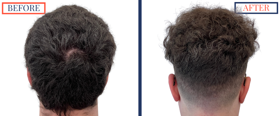 1385 graft FUE hair transplant before and after back donor area view