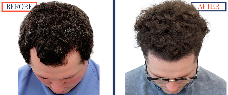 1385 graft FUE hair transplant before and after top profile view