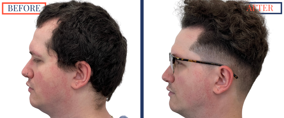 1385 graft FUE hair transplant before and after left profile view