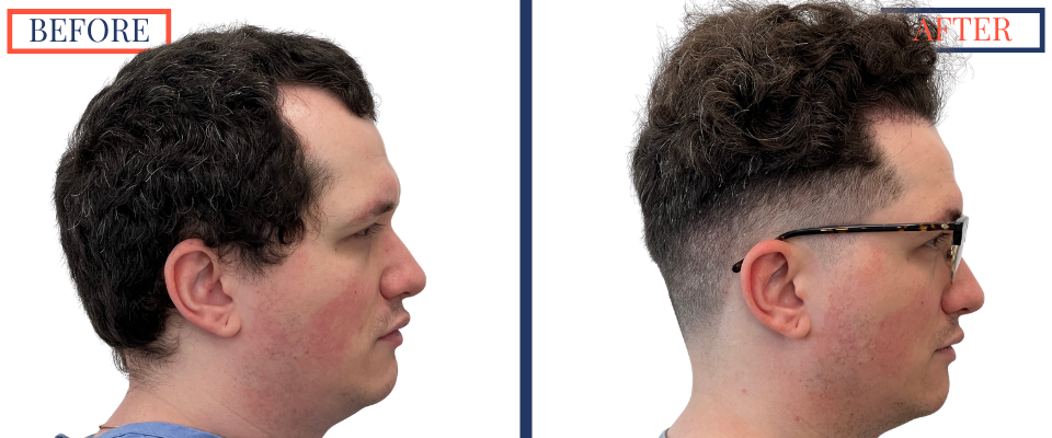 1385 graft FUE hair transplant before and after right profile view