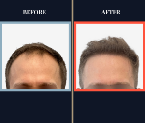 2415 G FUE Hair transplant feature image