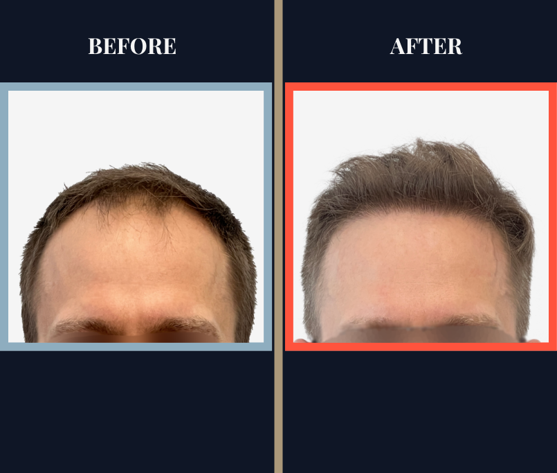 2415 G FUE Hair transplant feature image