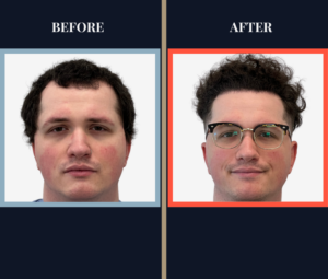 1385 graft FUE HAIR TRANSPLANT feature image