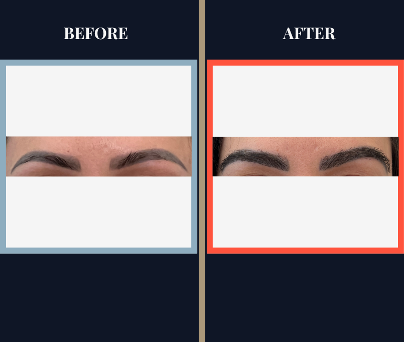 FUT Eyebrow Hair Transplant Before and After - Feature Image showing both brows.