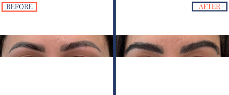 FUT Eyebrow Hair Transplant Before and After - FRONT VIEW of both brows