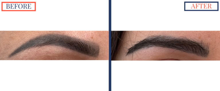 FUT Eyebrow Hair Transplant Before and After - Zoom on left brow only