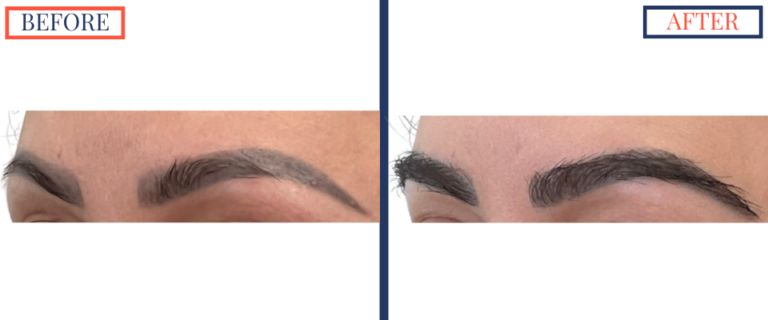 FUT Eyebrow Hair Transplant Before and After - Left oblique view