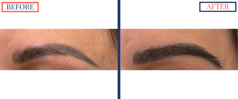 FUT Eyebrow Hair Transplant Before and After - Right Brow Zoomed in
