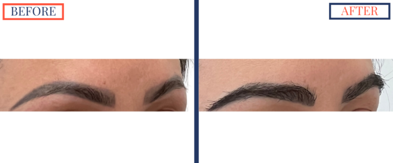 FUT Eyebrow Hair Transplant Before and After - zoom on Right oblique view