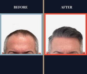 Before and After - 2369 graft FUE hair transplant - feature image front view