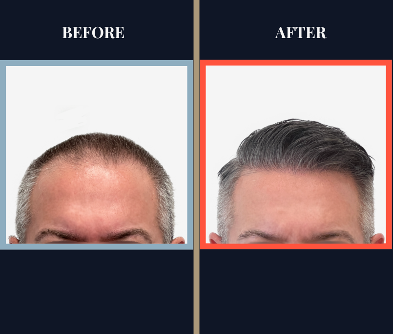 Before and After - 2369 graft FUE hair transplant - feature image front view