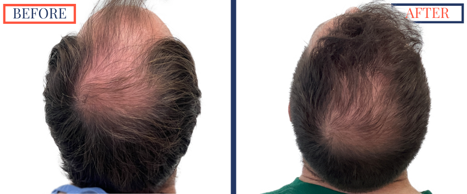 Before and After 2730 graft FUE hair transplant surgery - post-op back of the head view (donor area)