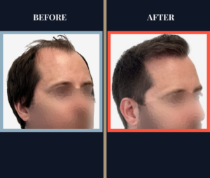 700 graft FUT Eyebrow Hair Transplant surgery before and after photos - feature image right oblique profile view