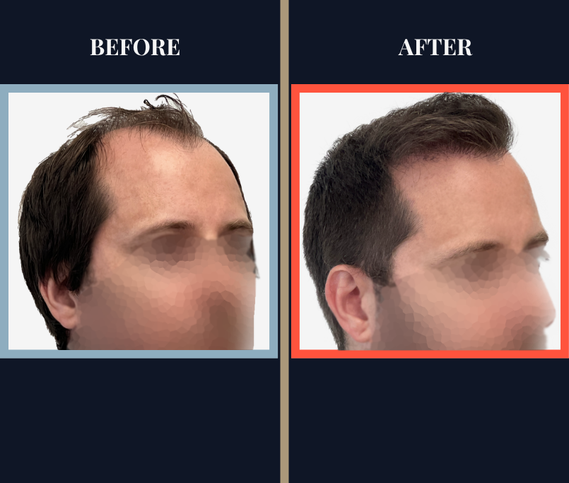 700 graft FUT Eyebrow Hair Transplant surgery before and after photos - feature image right oblique profile view