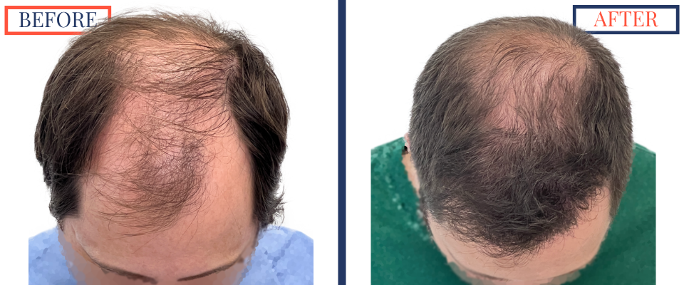 700 graft FUT Eyebrow Hair Transplant surgery before and after photos - front top down viewe