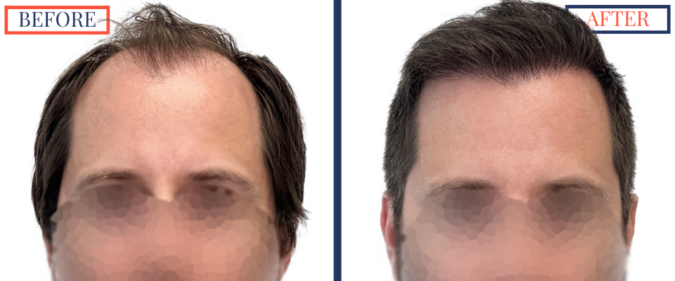 700 graft FUT Eyebrow Hair Transplant surgery before and after photos - front view