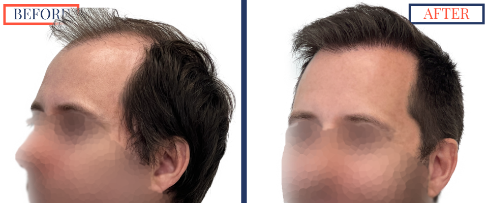 700 graft FUT Eyebrow Hair Transplant surgery before and after photos - left oblique view