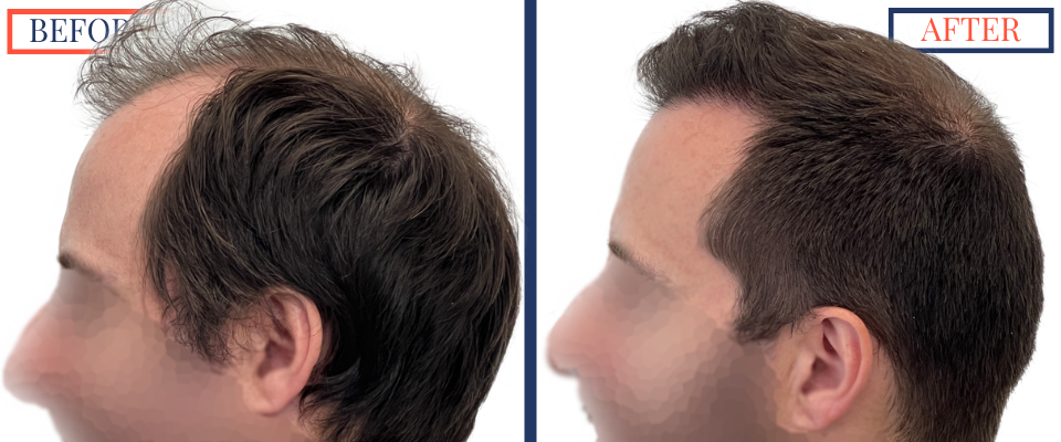 700 graft FUT Eyebrow Hair Transplant surgery before and after photos - left view