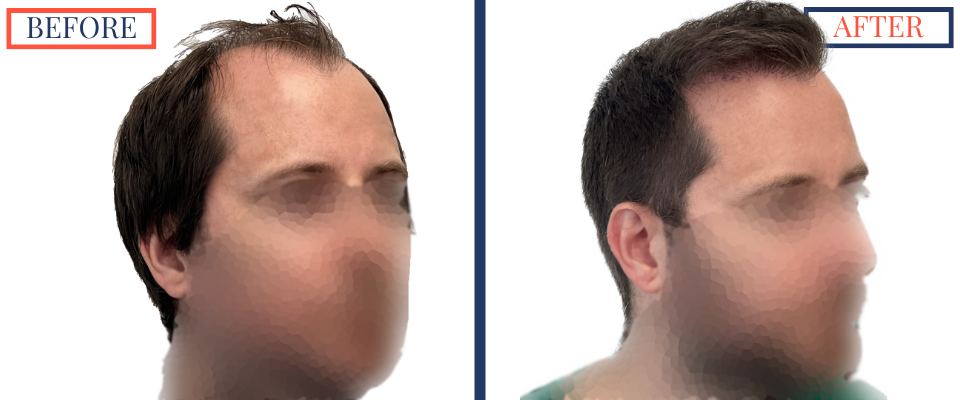 700 graft FUT Eyebrow Hair Transplant surgery before and after photos - right oblique view
