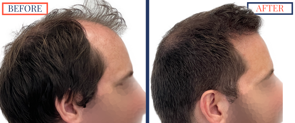 700 graft FUT Eyebrow Hair Transplant surgery before and after photos - right side view