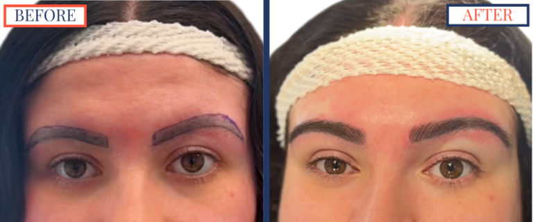 700 graft FUT Eyebrow Hair Transplant surgery before and after photos - pre-surgery and immediately post-op zoom in