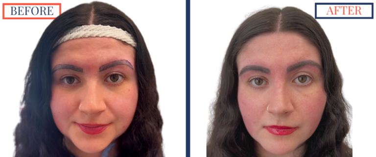 700 graft FUT Eyebrow Hair Transplant surgery before and after photos - pre-surgery and 2 weeks post op