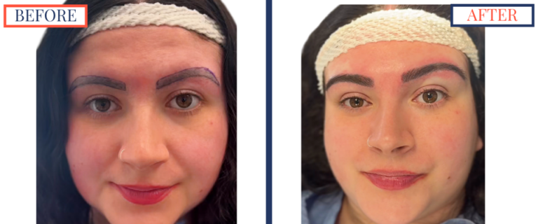 700 graft FUT Eyebrow Hair Transplant surgery before and after photos