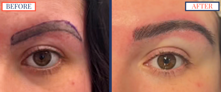 700 graft FUT Eyebrow Hair Transplant surgery before and after photos - zoom on left brow