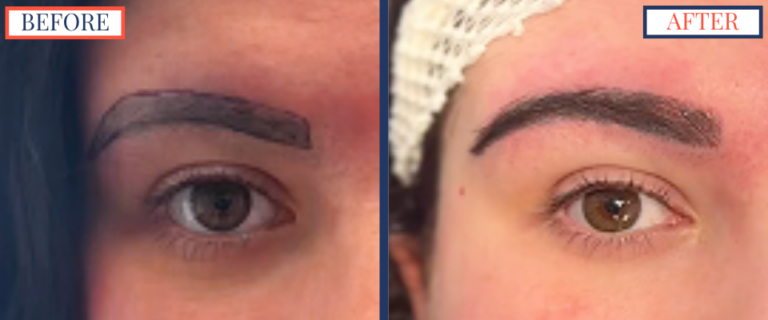 700 graft FUT Eyebrow Hair Transplant surgery before and after photos - zoom on right brow