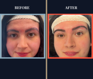 700 graft FUT Eyebrow Hair Transplant surgery before and after photos