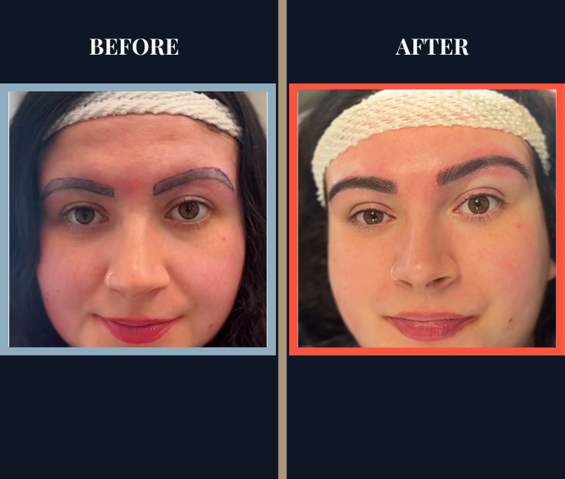 700 graft FUT Eyebrow Hair Transplant surgery before and after photos
