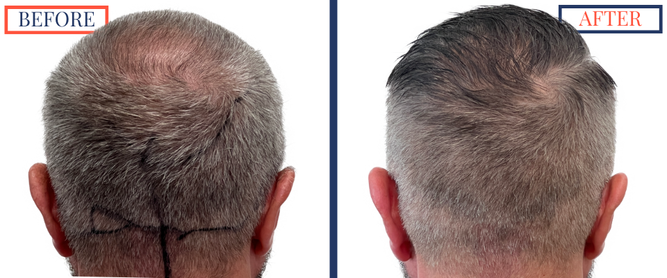 Before and After - 2369 graft FUE hair transplant - back view (donor area)