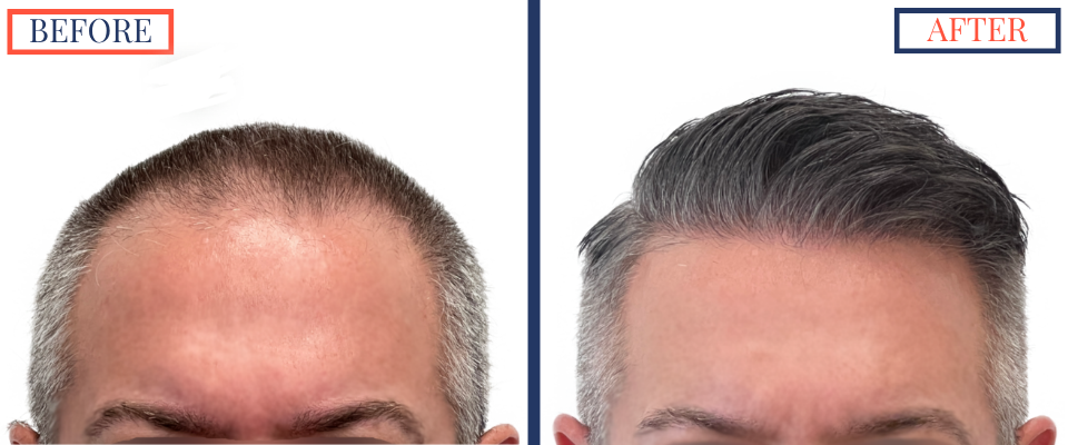 Before and After - 2369 graft FUE hair transplant -front view