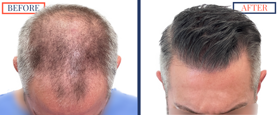 Before and After - 2369 graft FUE hair transplant -front top down view