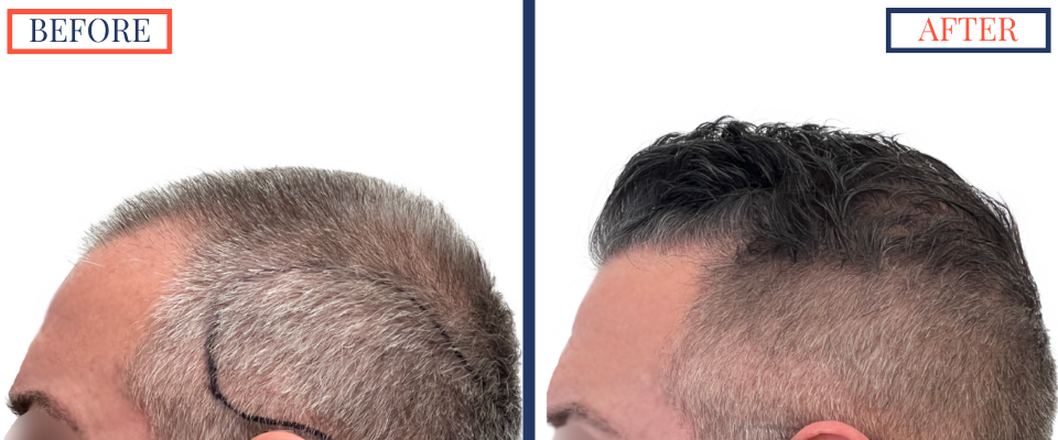 Before and After - 2369 graft FUE hair transplant - left view