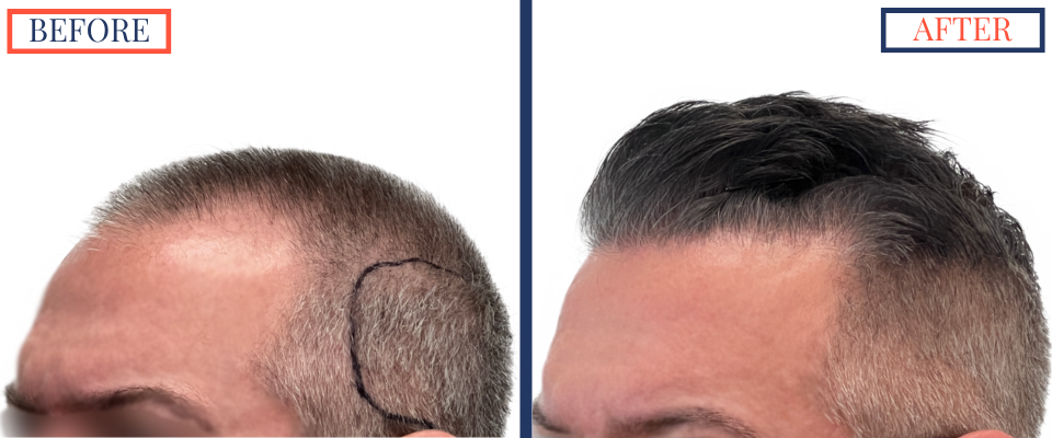 Before and After - 2369 graft FUE hair transplant -Left Oblique