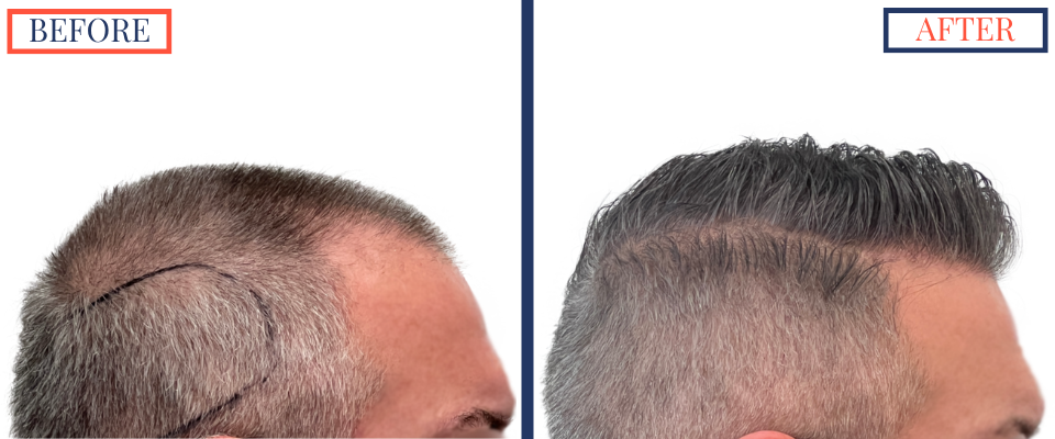 Before and After - 2369 graft FUE hair transplant -Right view