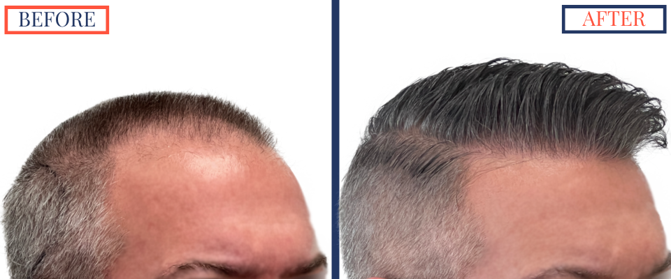 Before and After - 2369 graft FUE hair transplant - right oblique view