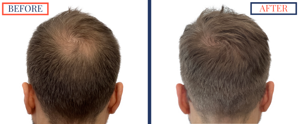 2415 Graft FUE Hair Transplant Result - Back Donor Area view before and after