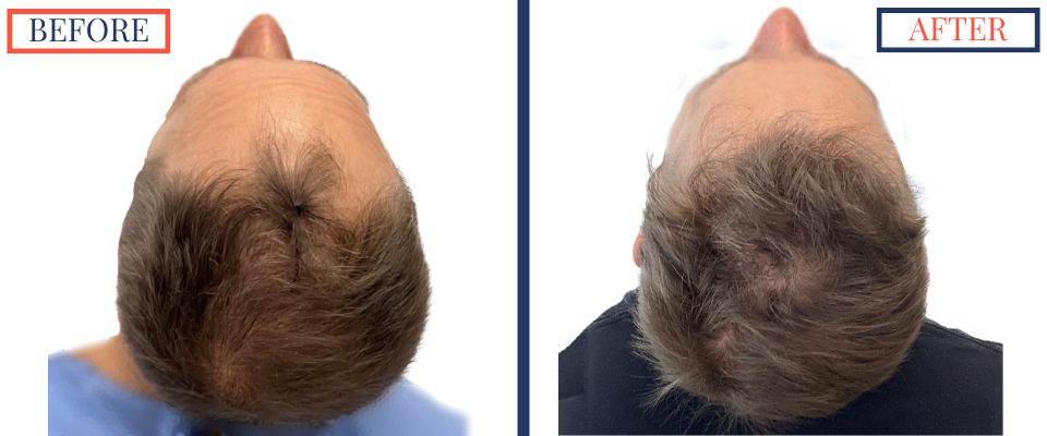 2415 Graft FUE Hair Transplant Result - Back and Top view before and after